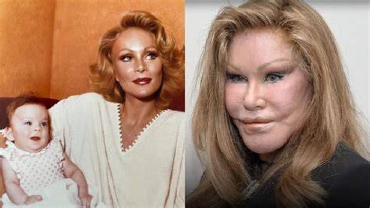 Cat Woman Plastic Surgery Before And After