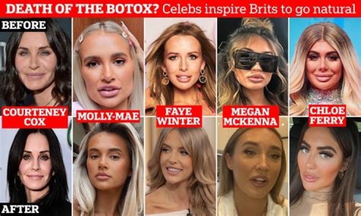 Celebrities Who Use Dermal Fillers Injectables Dubai