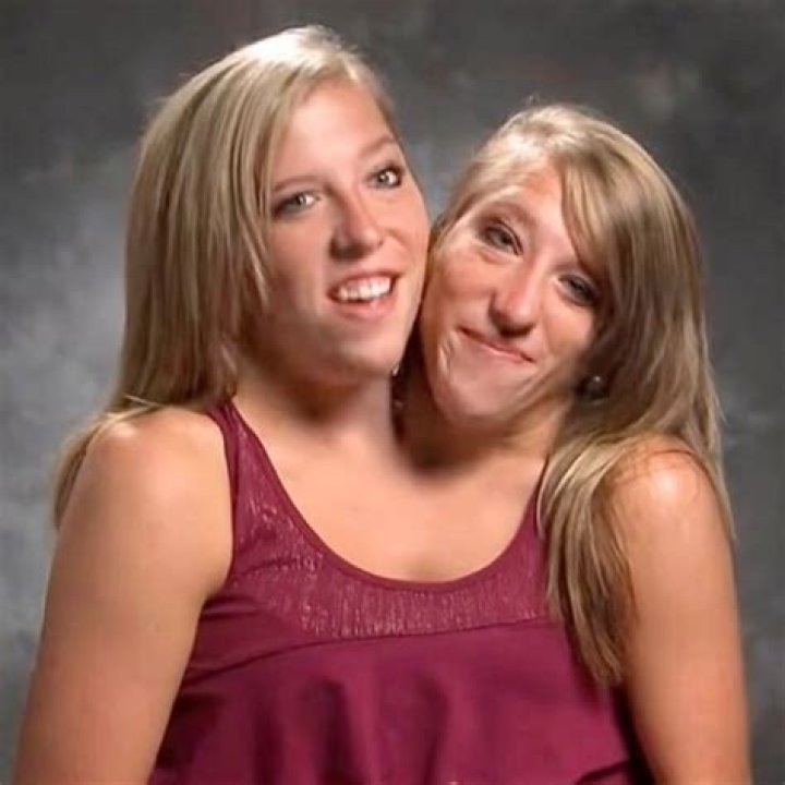 Conjoined Twins Abby and Brittany’s Exciting News! (2022)