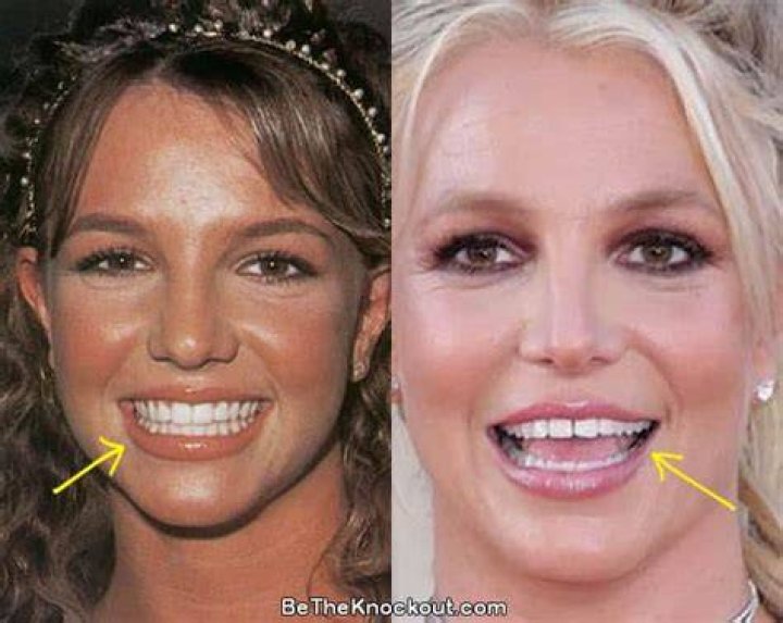 Did Britney&rsquo;s teeth change because of the conservatorship? Or is it
