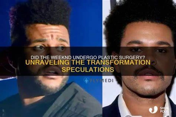 did the weeknd have plastic surgery