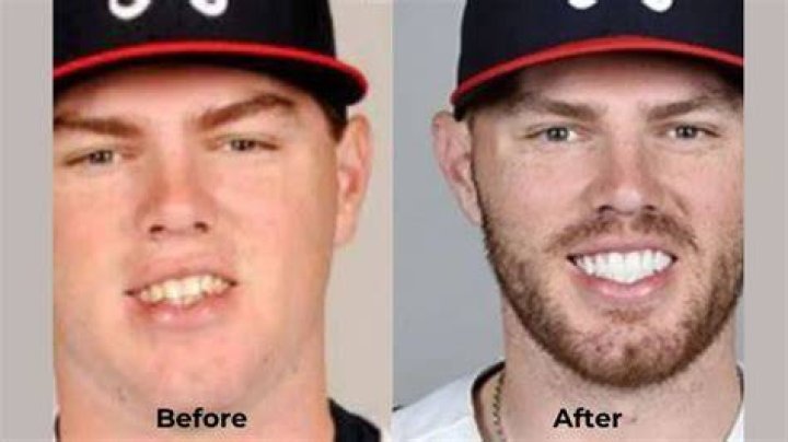 Does Freddie Freeman have veneers on his teeth? The US Sun