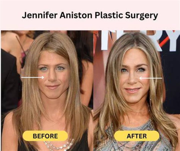 Jennifer Aniston Plastic Surgery Before & After Photos