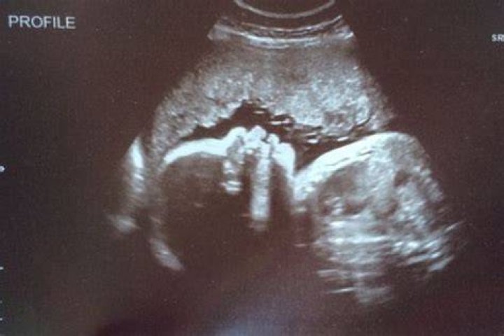 Protruding Lips On Ultrasound