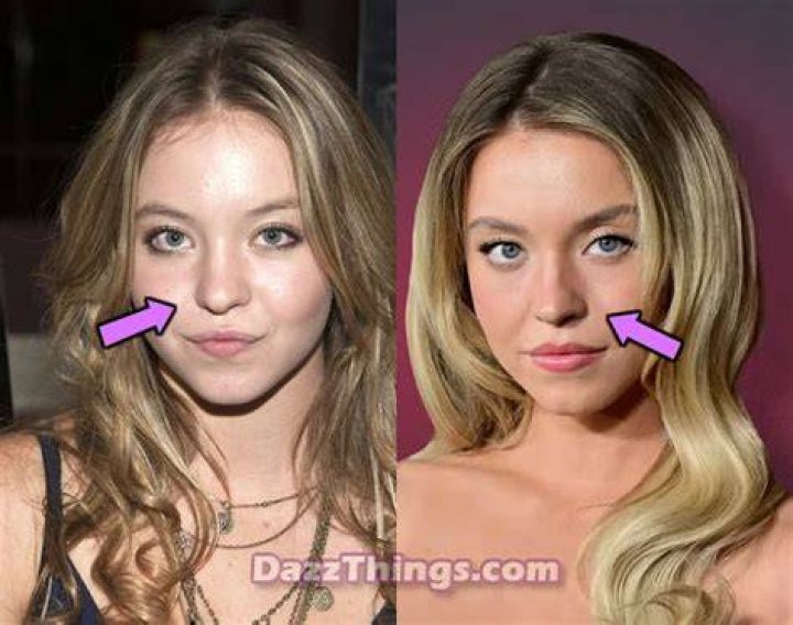 Sydney Sweeney Plastic Surgery Before and After. Nose Job, Facelift