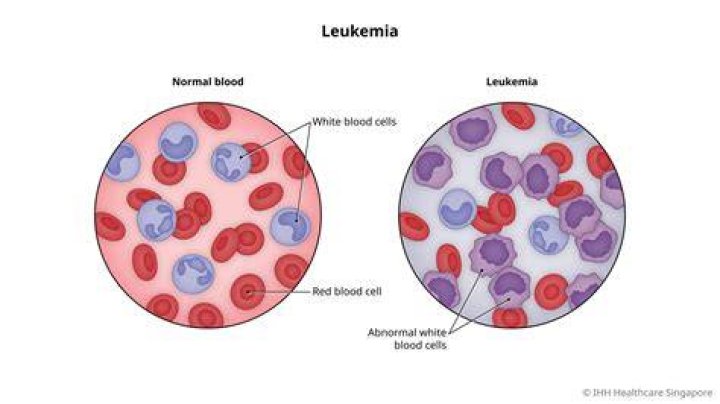 What Type of Leukemia Does Suleika Jaouad Have? Illness And Health 2023